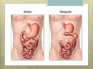 GASTRECTOMIA: INDICACIONESEn caso de problemas gástricos crónicos como úlceras, obesidad o cáncer, se puede recomendar la extirpación parcial o total del estómago. 