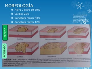 MORFOLOGÍA
 Píloro y antro 50-60%
 Cardias 25%
 Curvatura menor 40%
 Curvatura mayor 12%
PRECOZAVANZADO
Asociación Americana de
Cancerología.2011.
Patología estructural y
funcional. Robbins y Cotran
págs. 813-831.Manual de
Oncología Pags. 579-593.
 