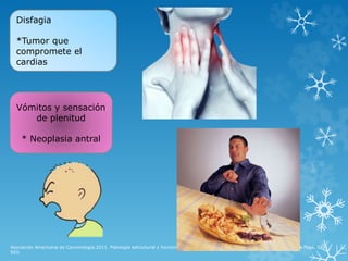 Asociación Americana de Cancerología.2011. Patología estructural y funcional. Robbins y Cotran págs. 813-831.Manual de Oncología Pags. 579-
593.
Vómitos y sensación
de plenitud
* Neoplasia antral
Disfagia
*Tumor que
compromete el
cardias
 