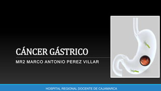 CÁNCER GÁSTRICO
MR2 MARCO ANTONIO PEREZ VILLAR
HOSPITAL REGIONAL DOCENTE DE CAJAMARCA
 