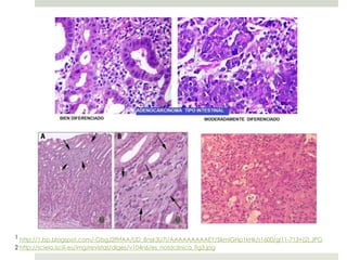 1 http://1.bp.blogspot.com/-GbgJ2ffrfAA/UD_8nsk3U7I/AAAAAAAAAEY/5kmiGHp1kHk/s1600/gl11-713+(2).JPG
2 http://scielo.isciii.es/img/revistas/diges/v104n6/es_notaclinica_fig3.jpg
 