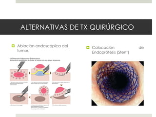 ALTERNATIVAS DE TX QUIRÚRGICO
 Ablación endoscópica del
tumor.
 Colocación de
Endoprótesis (Stent)
 