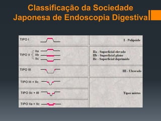 Classificação da Sociedade
Japonesa de Endoscopia Digestiva
 