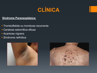 CLÍNICA
Síndrome Paraneoplásica:
 Tromboflebite ou trombose recorrente
 Ceratose seborrêica difusa
 Acantose nigrans
 Síndrome nefrótica
 