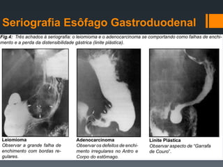 Seriografia Esôfago Gastroduodenal
 