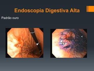 Endoscopia Digestiva Alta
Padrão ouro
 