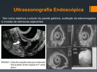 Ultrassonografia Endoscópica
Tem como objetivos o estudo da parede gástrica, avaliação de adenomegalias
e invasão de estruturas adjacentes
 