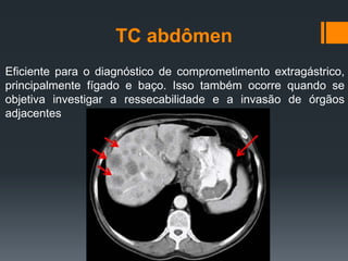 TC abdômen
Eficiente para o diagnóstico de comprometimento extragástrico,
principalmente fígado e baço. Isso também ocorre quando se
objetiva investigar a ressecabilidade e a invasão de órgãos
adjacentes
 