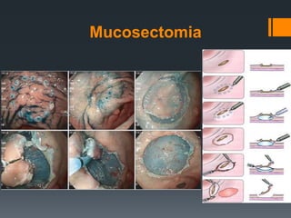 Mucosectomia
 