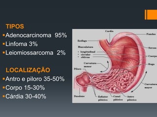 TIPOS
Adenocarcinoma 95%
Linfoma 3%
Leiomiossarcoma 2%
LOCALIZAÇÃO
Antro e piloro 35-50%
Corpo 15-30%
Cárdia 30-40%
 