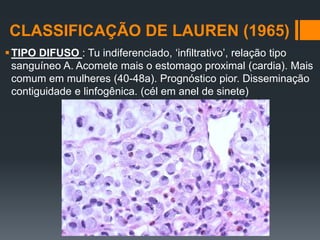 CLASSIFICAÇÃO DE LAUREN (1965)
TIPO DIFUSO : Tu indiferenciado, ‘infiltrativo’, relação tipo
sanguíneo A. Acomete mais o estomago proximal (cardia). Mais
comum em mulheres (40-48a). Prognóstico pior. Disseminação
contiguidade e linfogênica. (cél em anel de sinete)
 