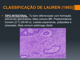 CLASSIFICAÇÃO DE LAUREN (1965)
 TIPO INTESTINAL : Tu bem diferenciado com formação
estruturas glandulares. Mais comum BR. Predominância
homem (2:1) (55-60 a). Lesões expansivas, polipoides e
ulceradas. Mais comum estômago distal.
 