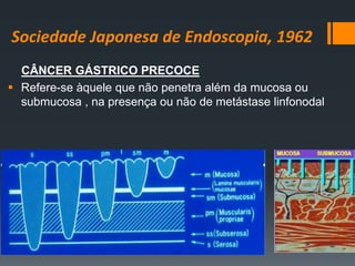 Sociedade Japonesa de Endoscopia, 1962
CÂNCER GÁSTRICO PRECOCE
 Refere-se àquele que não penetra além da mucosa ou
submucosa , na presença ou não de metástase linfonodal
 