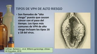 TIPOS DE VPH DE ALTO RIESGO
› Son llamados de “alto
riesgo” puesto que causan
cáncer con el paso del
tiempo. Los tipos más
comunes de VPH de alto
riesgo incluyen los tipos 16
y 18 del virus.
Hoffman, Barbara L., et al. Williams gynecology. cGraw-
Hill Education, 2016.
 