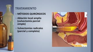 TRATAMIENTO
› MÉTODOS QUIRÚRGICOS
› Ablación local amplia
(vulvectomía parcial
simple)
› Vulvectomías radicales
(parcial y completa)
 