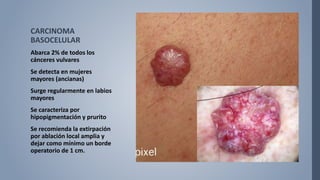 CARCINOMA
BASOCELULAR
Abarca 2% de todos los
cánceres vulvares
Se detecta en mujeres
mayores (ancianas)
Surge regularmente en labios
mayores
Se caracteriza por
hipopigmentación y prurito
Se recomienda la extirpación
por ablación local amplia y
dejar como mínimo un borde
operatorio de 1 cm.
 