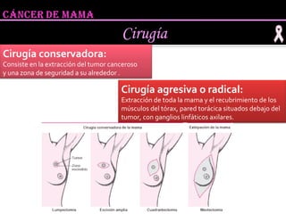 Cirugía Cirugía conservadora:  Consiste en la extracción del tumor canceroso  y una zona de seguridad a su alrededor . Cirugía agresiva o radical: Extracción de toda la mama y el recubrimiento de los músculos del tórax, pared torácica situados debajo del tumor, con ganglios linfáticos axilares. 