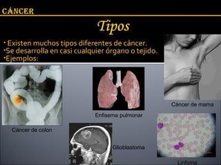 Existen muchos tipos diferentes de cáncer. Se desarrolla en casi cualquier órgano o tejido.  Ejemplos: Cáncer de mama Enfisema pulmonar Cáncer de colon Linfoma Glioblastoma 