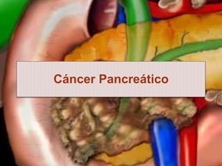 Cáncer Pancreático
 