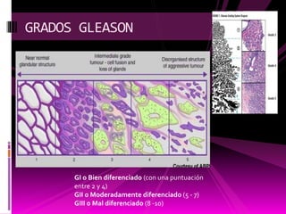 GRADOS GLEASON
GI o Bien diferenciado (con una puntuación
entre 2 y 4)
GII o Moderadamente diferenciado (5 - 7)
GIII o Mal diferenciado (8 -10)
 