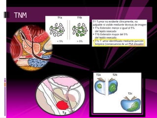 TNM
 
