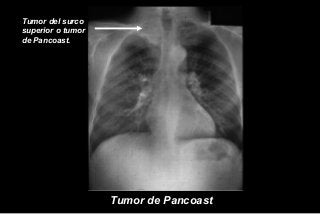 Tumor del surco
superior o tumor
de Pancoast.
Tumor de Pancoast
 