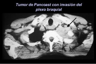 Tumor de Pancoast con invasión del
plexo braquial
 
