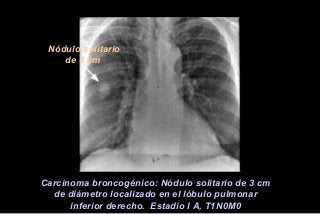Nódulo solitario
de 3 cm
Carcinoma broncogénico: Nódulo solitario de 3 cm
de diámetro localizado en el lóbulo pulmonar
inferior derecho. Estadio I A, T1N0M0
 