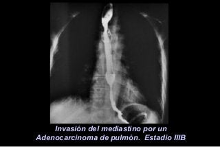 Invasión del mediastino por un
Adenocarcinoma de pulmón. Estadio IIIB
 