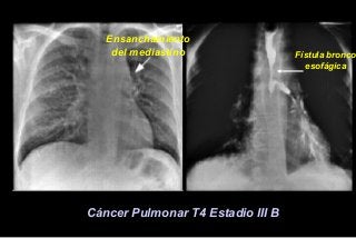 Fístula bronco
esofágica
Ensanchamiento
del mediastino
Cáncer Pulmonar T4 Estadio III B
 