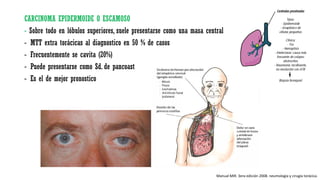 CARCINOMA EPIDERMOIDE O ESCAMOSO
- Sobre todo en lóbulos superiores, suele presentarse como una masa central
- MTT extra torácicas al diagnostico en 50 % de casos
- Frecuentemente se cavita (20%)
- Puede presentarse como Sd. de pancoast
- Es el de mejor pronostico
Manual MIR. 3era edición 2008. neumología y cirugía torácica.
 