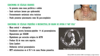 CARCINOMA DE CÉLULAS GRANDES
- Se presenta como masa periférica o nódulo
- Suele cavitarse (menos que epidermoide)
- Frecuentemente metástasis extra torácicas
- Puede presentar ginecomastia como Sd. para-neoplásico
CARCINOMA DE CÉLULAS PEQUEÑAS O MICROCITICA, EN GRANO DE AVENA U “OAT CELL”
- Masa central + adenopatías
- Usualmente secreta hormonas-péptidos  sd. paraneoplasicos.
- Hiponatremia por SSIADH
- Hipokalemia por secreción ectópica de ACTH
- Produce Sd. de vena cava superior.
- Eaton Lambert
- Disfuncion cortical paraneoplasica
- MTT extratoracicas en el 95 % de casos. Pesimo pronostico.
Manual MIR. 3era edición 2008. neumología y cirugía torácica.
 