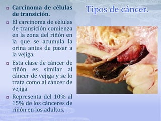 Tipos de cáncer.Carcinoma de células de transición.El carcinoma de células de transición comienza en la zona del riñón en la que se acumula la orina antes de pasar a la vejiga. Esta clase de cáncer de riñón es similar al cáncer de vejiga y se lo trata como al cáncer de vejigaRepresenta del 10% al 15% de los cánceres de riñón en los adultos.