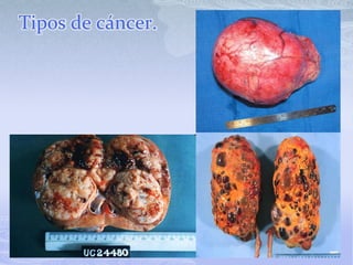 Tipos de cáncer.