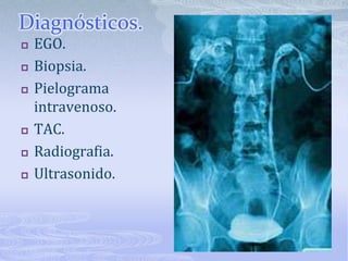 Diagnósticos.<br />EGO.<br />Biopsia.<br />Pielograma intravenoso.<br />TAC.<br />Radiografia.<br />Ultrasonido.<br />