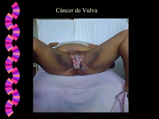 Cáncer de Vulva
 