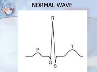 NORMAL WAVE 