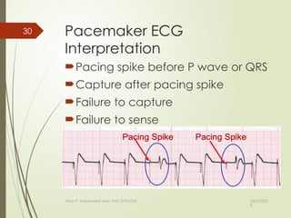 Comprehensive Guide to Heart Block and Pacemaker Monitoring for Nursing ...