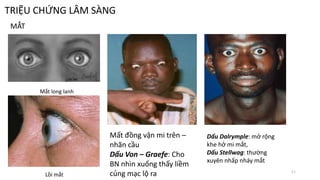 TRIỆU CHỨNG LÂM SÀNG
MẮT
Mắt long lanh
Lồi mắt
Mất đồng vận mi trên –
nhãn cầu
Dấu Von – Graefe: Cho
BN nhìn xuống thấy liềm
củng mạc lộ ra
Dấu Dalrymple: mở rộng
khe hở mi mắt,
Dấu Stellwag: thường
xuyên nhấp nháy mắt
11
 