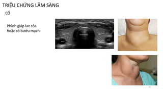 TRIỆU CHỨNG LÂM SÀNG
CỔ
Phình giáp lan tỏa
hoặc có bướu mạch
12
 