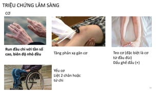 TRIỆU CHỨNG LÂM SÀNG
CƠ
Run đầu chi với tần số
cao, biên độ nhỏ đều Tăng phản xạ gân cơ Teo cơ (đặc biệt là cơ
tứ đầu đùi)
Dấu ghế đẩu (+)
Yếu cơ
Liệt 2 chân hoặc
tứ chi
14
 
