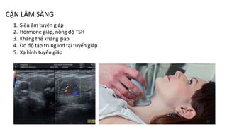 CẬN LÂM SÀNG
1. Siêu âm tuyến giáp
2. Hormone giáp, nồng độ TSH
3. Kháng thể kháng giáp
4. Đo độ tập trung iod tại tuyến giáp
5. Xạ hình tuyến giáp
15
 