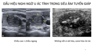 18
DẤU HIỆU NGHI NGỜ U ÁC TÍNH TRONG SIÊU ÂM TUYẾN GIÁP
Chiều cao > chiều ngang Những nốt vi vôi hóa, canxi hóa rải rác
 