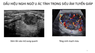 19
DẤU HIỆU NGHI NGỜ U ÁC TÍNH TRONG SIÊU ÂM TUYẾN GIÁP
Xâm lấn vào mô xung quanh Tăng sinh mạch máu
 