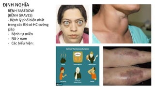 ĐỊNH NGHĨA
BỆNH BASEDOW
(BỆNH GRAVES)
- Bệnh lý phổ biến nhất
trong các BN có HC cường
giáp
- Bệnh tự miễn
- Nữ > nam
- Các biểu hiện:
3
 