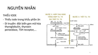 NGUYÊN NHÂN
THIẾU IODE
- Thiếu iode trong khẩu phần ăn
- Di truyền: đột biến gen mã hóa
thyroglobulin, thyroxin
peroxidase, TSH receptor,...
31
 
