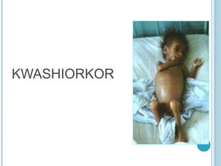 KWASHIORKOR
 