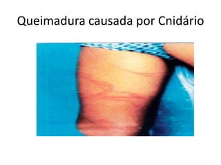 Queimadura causada por Cnidário
 