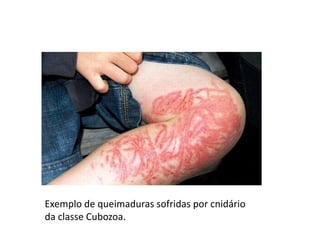 Exemplo de queimaduras sofridas por cnidário
da classe Cubozoa.
 