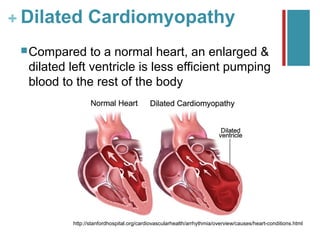 + Dilated Cardiomyopathy
  Compared    to a normal heart, an enlarged &
  dilated left ventricle is less efficient pumping
  blood to the rest of the body




          http://stanfordhospital.org/cardiovascularhealth/arrhythmia/overview/causes/heart-conditions.html
 